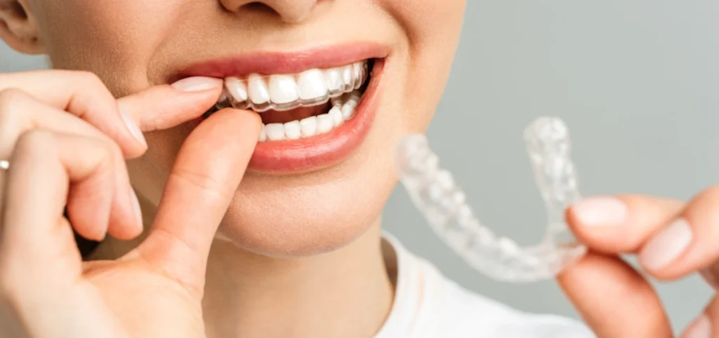 Aligneurs transparents à Gaillard, Drs PEIROLO et BIRGY, orthodontistes près de Genève