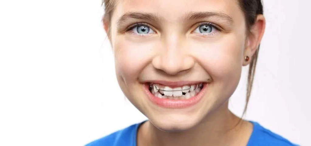 Plaque palatine en orthodontie pour enfants à Gaillard, près de Genève