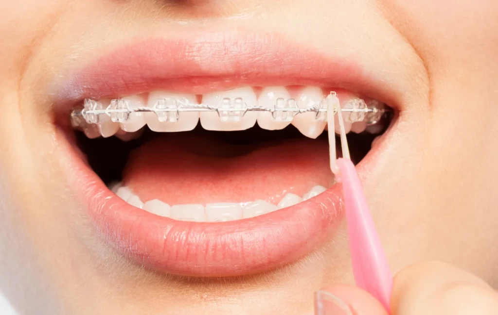 Port des élastiques, Orthodontiste Gaillard, près de Genève