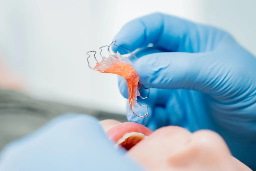 Plaque palatine en orthodontie pour enfants à Gaillard
